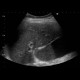 Primary sclerosing cholangoitis, sludge: US - Ultrasound